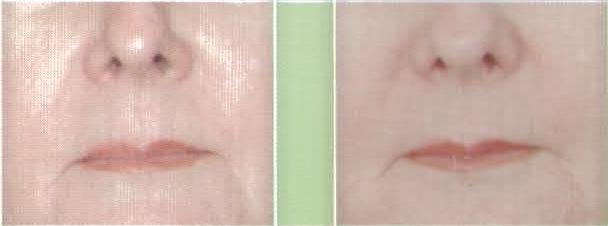 Rejuvenecimiento Facial Laser - Labio Superior e Inferior