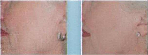 Rejuvenecimiento Facial Laser - Ovalo Facial