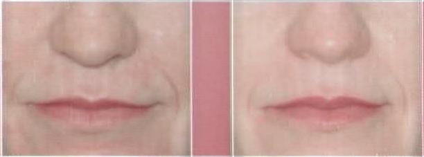 Rejuvenecimiento Facial Laser - Surco Nasogeniano