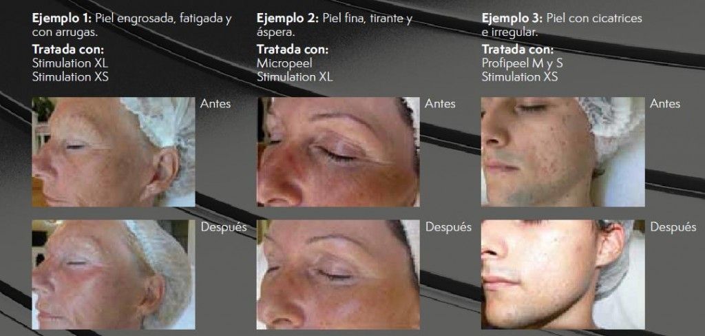 Antes y Despues BDR
