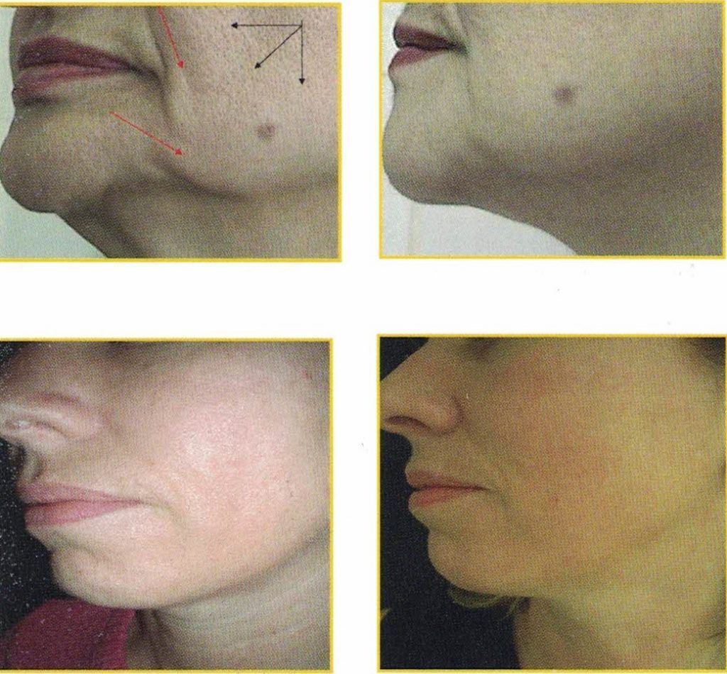 carboxiterapia facial