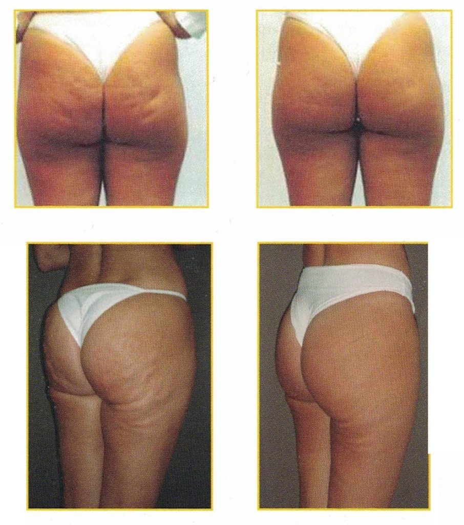 carboxiterapia celulitis y contorno corporal